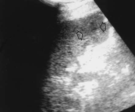 C, Computed tomographic scan showing a lacerated contusive area within the spleen (arrow;