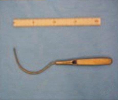 (B) The puncture point by the Shimada needle is 3 cm down on a vertical line from a point 3 cm lateral to the anal verge. (C) The original Shimada needle developed in Japan.