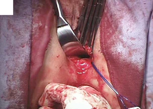 (C) The placement of the anterior part with the four cannula-equipped guides.