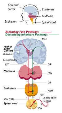 pain induce changes in the CNS and PNS producing sensitization Peripheral nerves become more receptive to pain (wind up) How pain signal is processed in spinal cord changes Loss of descending