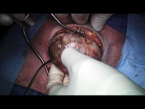 Removal of a mass and thyroid gland: