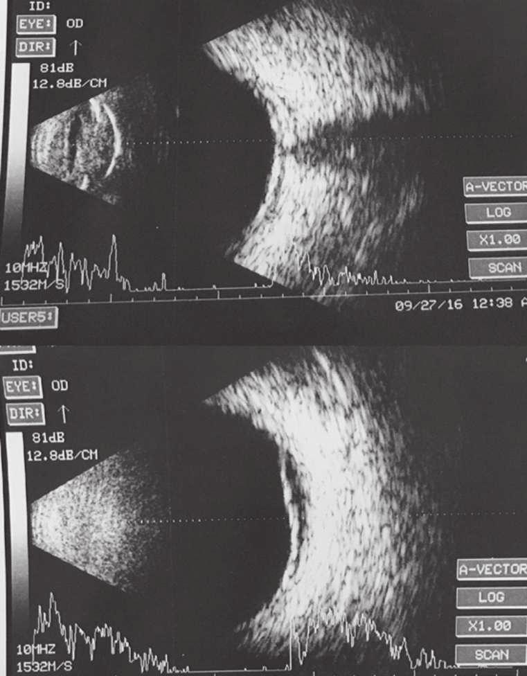 left eye showing serous retinal detachment in the inferior wall and choroidal thickening in temporal wall. Figure 2:.