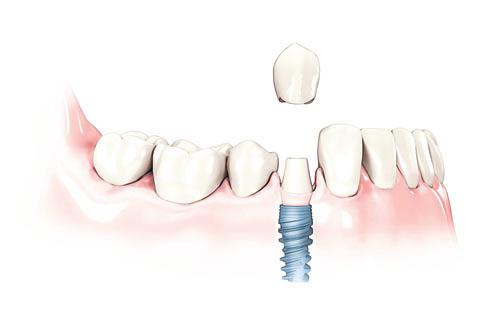 Replacement teeth on dental implants Dental implants are inserted into your jaw bone and act just like the tooth roots of your natural teeth.