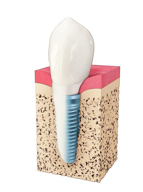 Crown Gum Tooth root Dental implant Jaw bone