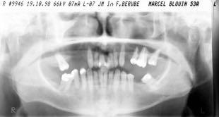 dento-alveolar mutilation & compensation -critical anchorage insufficiency -dental & skeletal