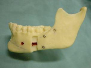 8.Bilateral sagittal split osteotomy 9.Post-op orthodontics 10.Prosthodontic wax-up 11.Final temporization 12.Final restorations 13.Orthodontic retention 14.