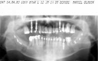 Post-op orthodontics