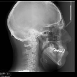 maxillary advancement Patient needs Patient needs 1. maxillary expansion 2.