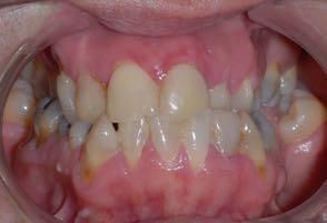good perio management 6. dental arch coordination 1. maxillary expansion 2. maxillary advancement 3. lower dental asymmetry correction 4. incisor compensation correction 5. good perio management 6.