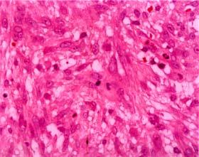 Fasicles of spindle cells with eosinophilic cytoplasm and spindled shape vesicular nuclei are also noted.