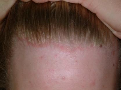 When should a child with pediatric plaque psoriasis