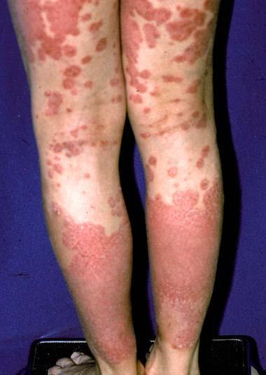 Systemic interventions for children and adolescents with plaque psoriasis Phototherapy Compliance in kids is difficult Methotrexate [69.2%] Retinoids [14.6%] Cyclosporine [7.7%] Fumaric acid [4.