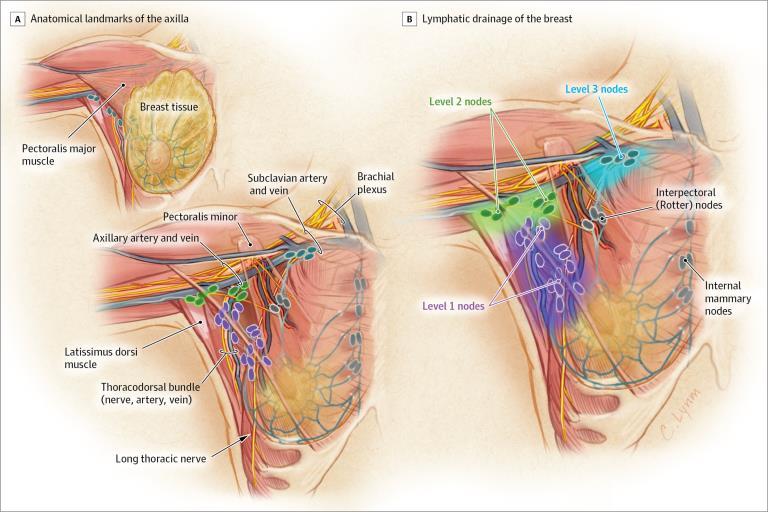 Is Axillary Node Dissection necessary?