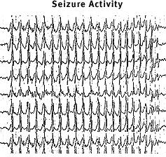 What is a seizure?