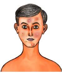 This reference summary will help you understand what acne is and how it can be treated. Anatomy Our body is covered with hair, except for a few areas.