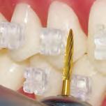 The PUE bonding base is coated with zirconia spheres creating millions of undercuts that mechanically lock with the bracket adhesive.