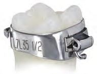 MOA BANDS Mandibular Prewelded Band and Tube Assemblies Available With or Without ingual Cleat Individual Assembly $6.