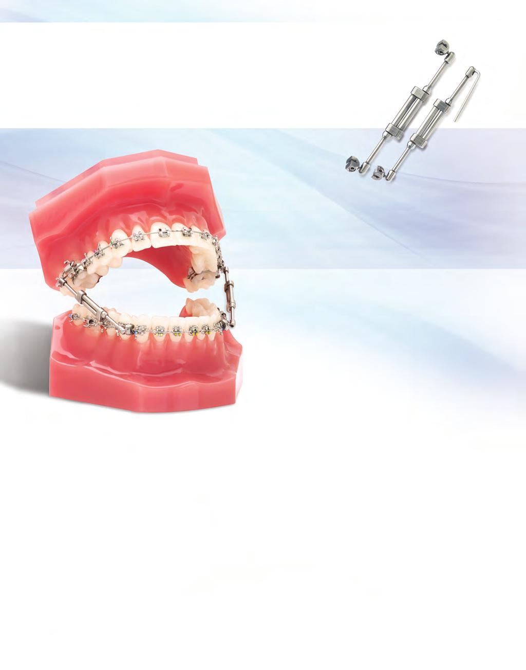ATTACHMENTS TruEase Bite Corrector Devices Innovative Orthodontic Intraoral Devices for the Correction of Class II and Class III