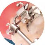 Springs Titanium Clamps & Screws Attachments Better esults with More Efficiency Help your non-compliant patients make the