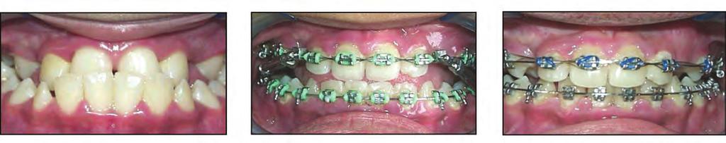 ATTACHMENTS TruEase Case Studies Bite Corrector Devices Class III Case Study Patient with Class III, missing upper canines, using the TruEase Double ock Bite Corrector Device.