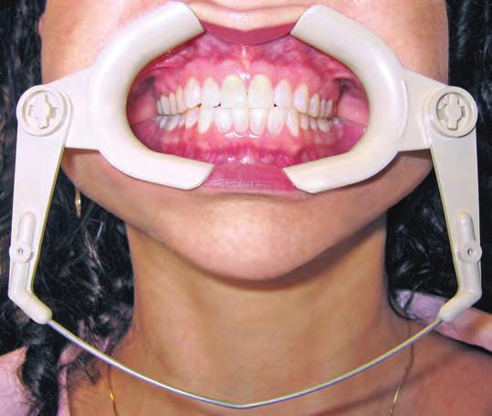 unobstructed view and superior buccal access Maintains accessibility during all types of procedures Safe for autoclave and dry heat sterilization