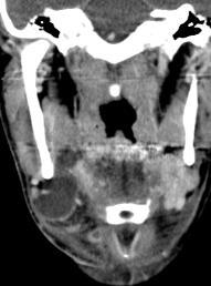 gland Simple: confined to sublingual space; horseshoe-shaped if bilateral