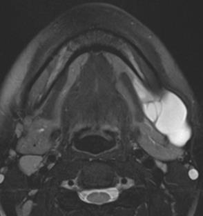 MRI   MRI T2 T1 T1 C+ FS Lymphatic