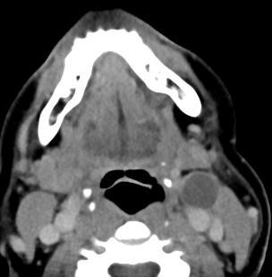 branchial cleft cyst Surgical pathology: irritated