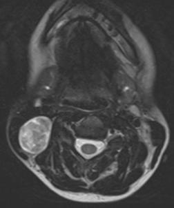 Nodal mass(es) in young female