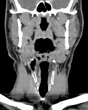 bright, no flow voids Intratumoral cysts if large In neck,