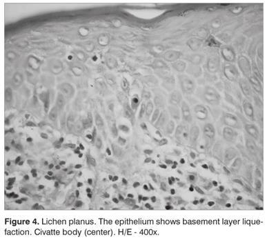 Lichen planus Histopathology: vacuolar alteration of the basal cell layer