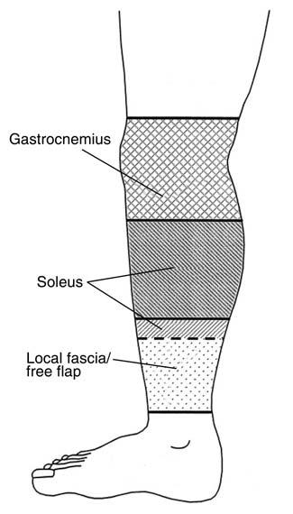 Open Tibial Shaft Fractures: II.