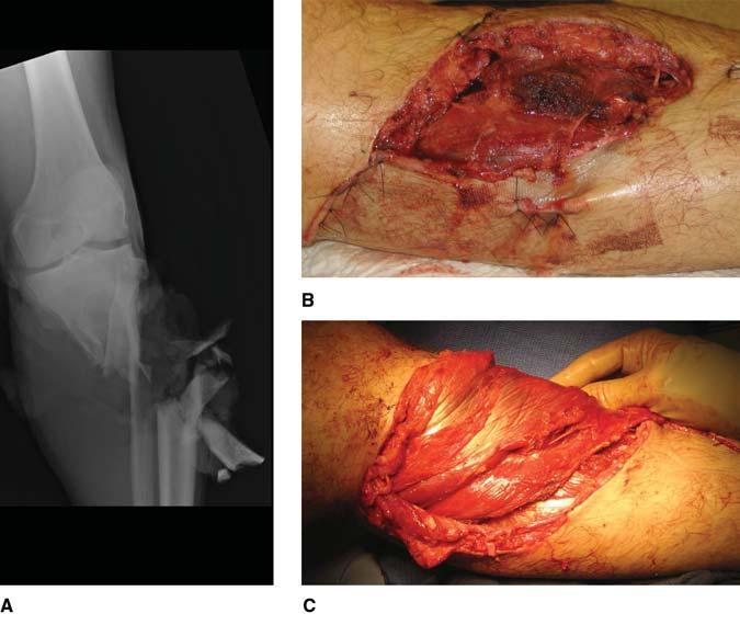 open tibial shaft fractures. (Adapted with permission from Hallock GG: Utility of both muscle and fascia flaps in severe lower extremity trauma. J Trauma 2000;48:913-917.