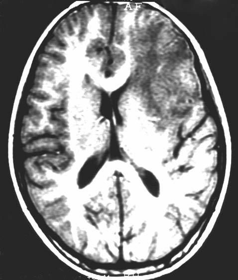 surrounding edema (Fig. 2-4). The clinical impression was that of an intrinsic brain tumor and a stereotactic biopsy was performed to avoid missed diagnosis.