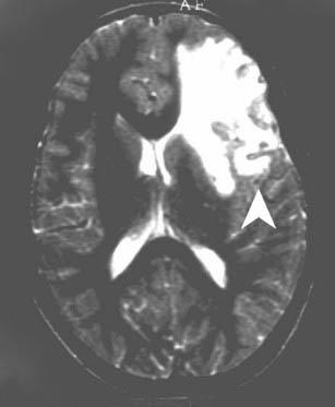 Wan et al.: Cerebral Schistosomiasis Fig. 3: Axial T2-weighted MRI of the brain showed hyper-intense signal in left frontal lobe (arrow) Fig.