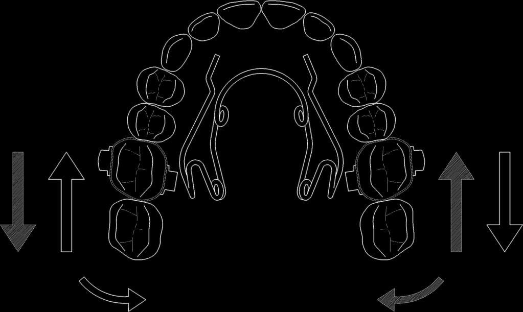tongue posture which cannot create buccal forces on the upper molars. While tongue activation potential is very difficult to measure on a routine basis, EMG measurements of m. masseter and m.