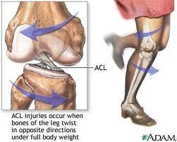ACL INJURY Extensive research Mechanism of injury Deceleration of knee rotation