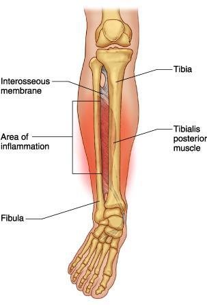 Overuse injury Occurs on the medial or lateral side of tibia (on shaft) Tearing of the interosseous membrane or