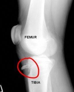 Despite its mineral strength, bone may crack or even break if subjected to extreme loads, sudden impacts, or stresses from unusual directions. The damage produced constitutes a fracture.