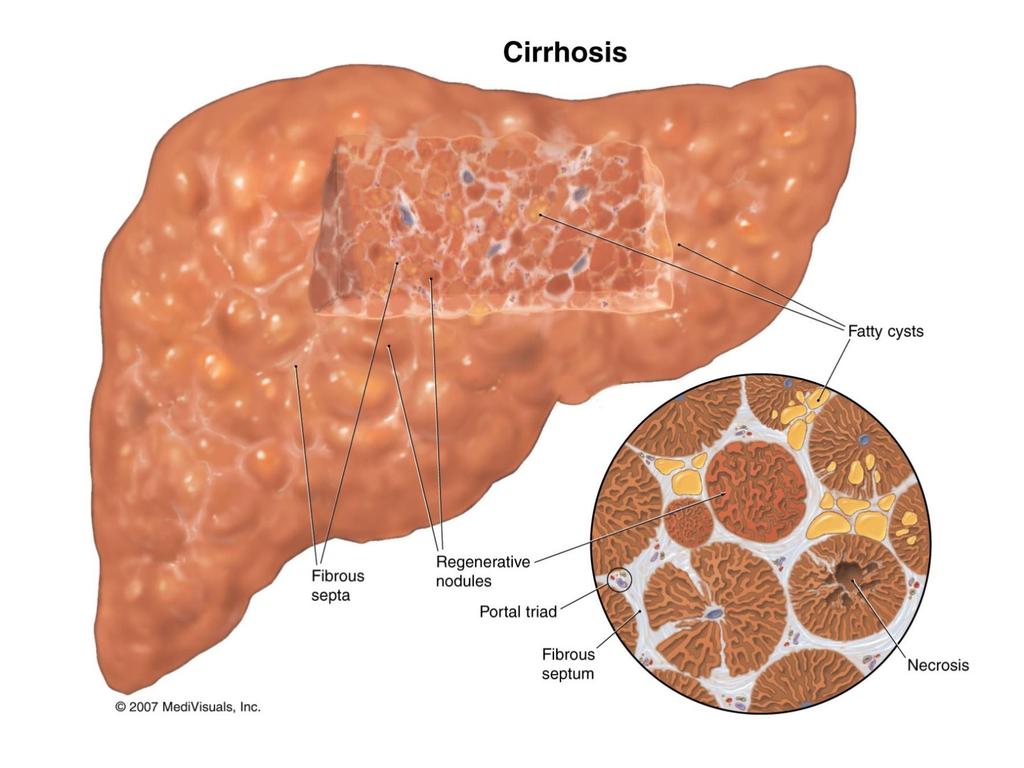 The three main characteristics of cirrhosis are (1) Involvement of most or all of the liver (2) Bridging fibrous septa