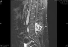 vertebral body and disk Progressive collapse, anterior wedging, and gibbus formation