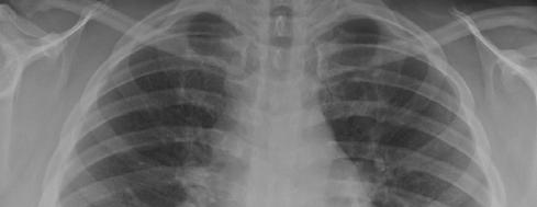CT scanning for optimal radiology evaluation Do you need a Chest CT to diagnose pulmonary tuberculosis?
