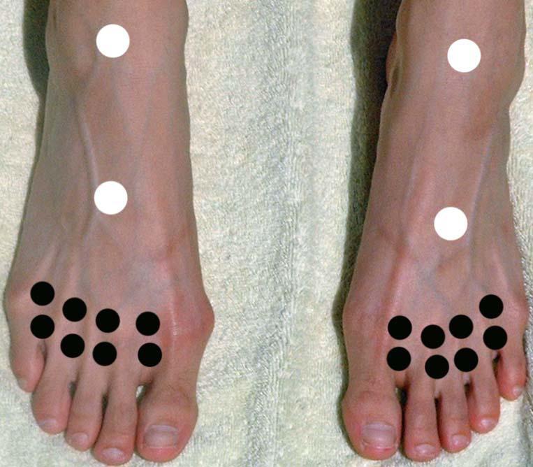 Pain Reducers Simultaneous, bilateral thumb circle white circles on top of foot