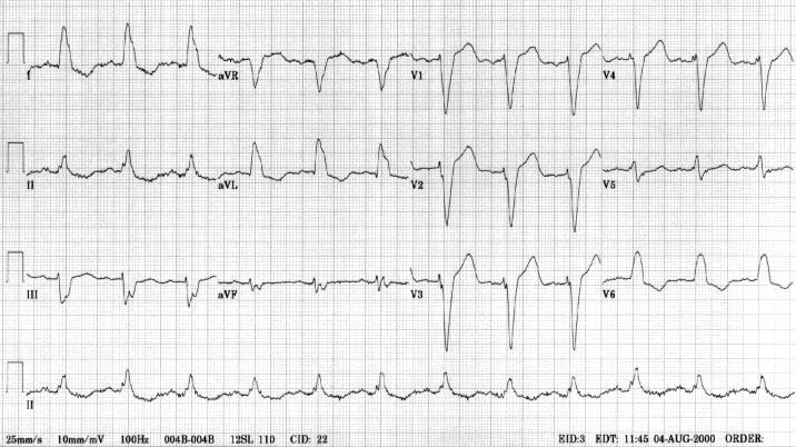 Biventricular Pacing LBBB common in HF patients Dyssynchrony between ventricles Biventricular pacing Pace right and left ventricle Improved cardiac