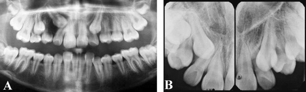 EVIDENCE FOR THE NEED OF A CT EXAMINATION 45 FIGURE 1. Panoramic (A) and intraoral periapical films (B) of ectopically positioned maxillary canines. TABLE 1.