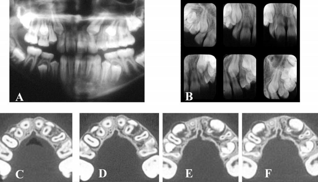 48 BJERKLIN, ERICSON FIGURE 3. Panoramic (A) and intraoral periapical films (B) of a 12-year and six-month-old girl.