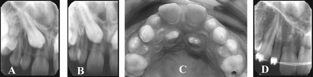 EVIDENCE FOR THE NEED OF A CT EXAMINATION 49 FIGURE 4. A 10-year-old girl with both maxillary canines ectopically erupted palatal to the dental arch (A C).