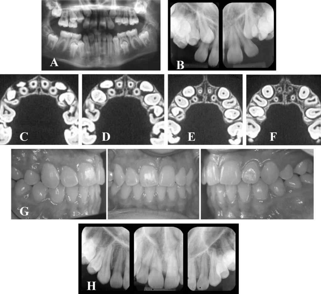50 BJERKLIN, ERICSON FIGURE 6. Panoramic and intraoral periapical films of a 10-year-old girl.