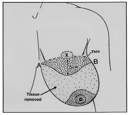 ) thickness circle of skin and fat was excised from the superior flap at the site of the new nipple-areola, and the NC complex was brought through to its new opening.