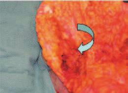 Small medial and larger lateral wedge excisions are marked to narrow the transverse diameter